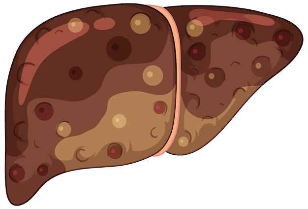 Causes of Fatty Liver Disease